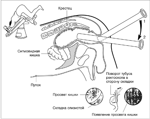 Как сделать клизму в домашних условиях ребенку 4 лет если нет груши Как сделать клизму в домашних условиях ребенку 4 лет если нет груши